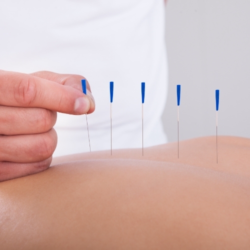 physical-therapy-clinic-dry-needling-Pro-Active-Physical-Therapy-Malvern-Benton-Sheridan-Bryant-AR