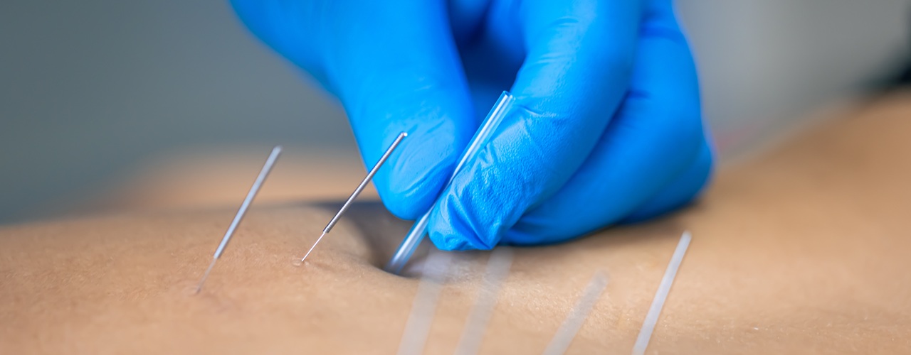 Your Dry Needling Quiz Results
